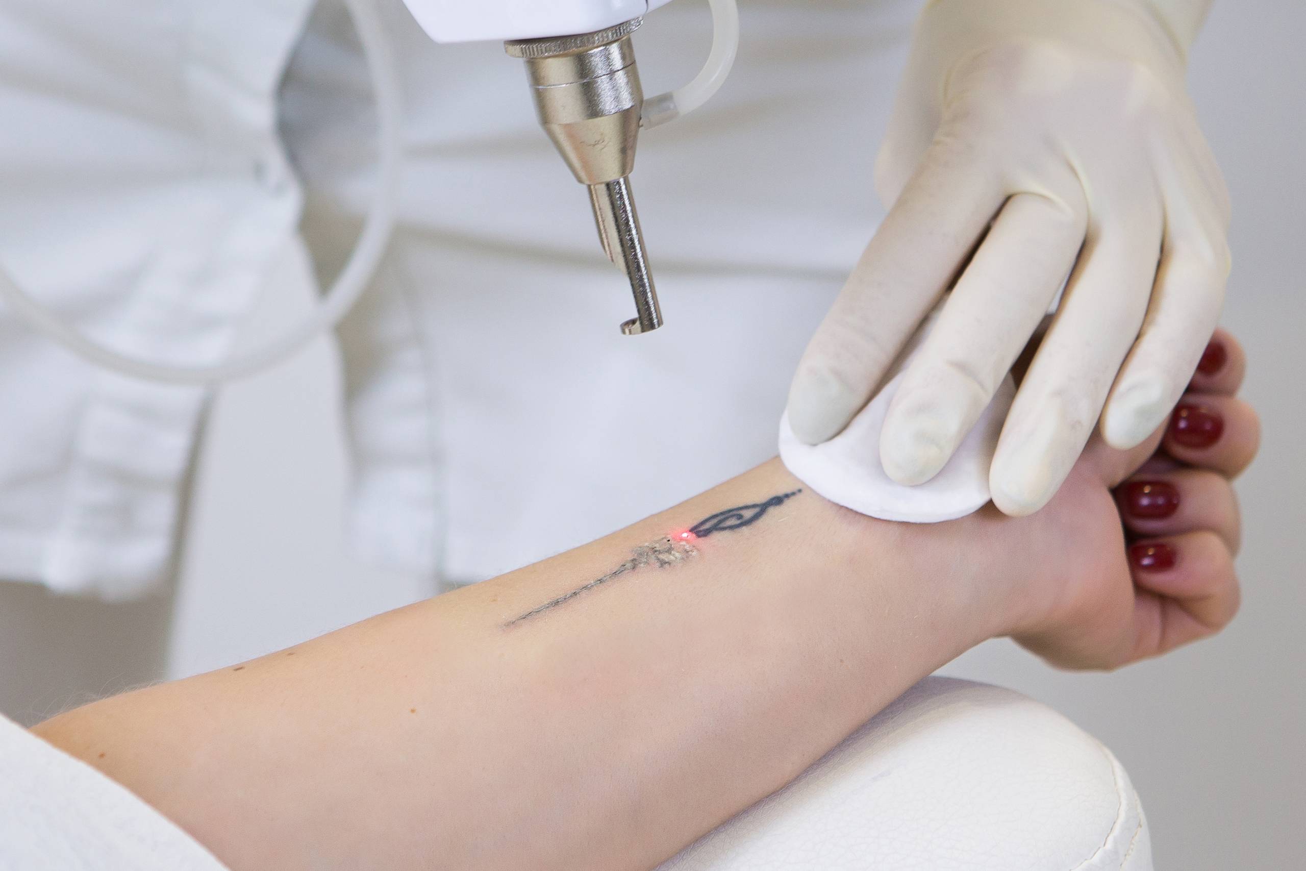 How To Treat Blisters After Tattoo Removal  Saved Tattoo